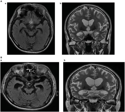 Whole Exome Sequencing Reveals a Novel APOE Mutation in a Patient With Sporadic Early-Onset Alzheimer's Disease